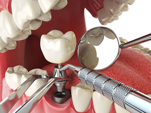 Best Knocked-Out Tooth Emergency  in Oyster Creek, TX